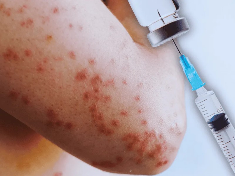Brote de sarampión en Nayarit activa alertas sanitarias en escuelas y comunidades